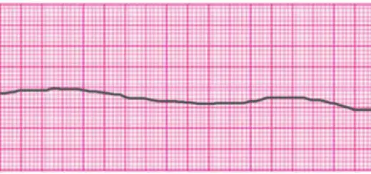 Image result for asystole